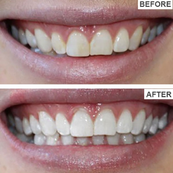JOYTEETH